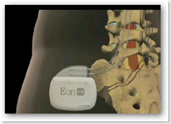 How Spinal Cord Stimulation Works - Relief for chronic back pain ...